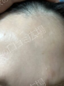 治療直後の症例写真