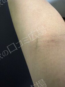 治療直後の症例写真