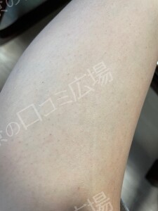 治療結果の症例写真