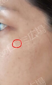 治療直後の症例写真