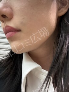 治療直後の症例写真