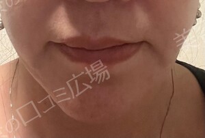 治療直後の症例写真