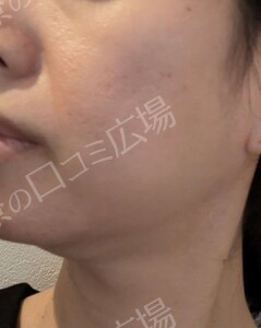 医療ハイフ｜頬・フェイスラインのたるみの治療結果の症例写真