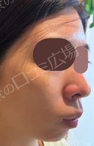 【初回限定】ピコトーニング＋ピコフラクショナル（全顔）の治療結果の症例写真
