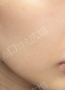 フォトフェイシャルStellar M22の治療前の症例写真