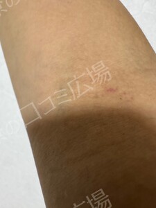 治療直後の症例写真