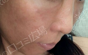 治療直後の症例写真
