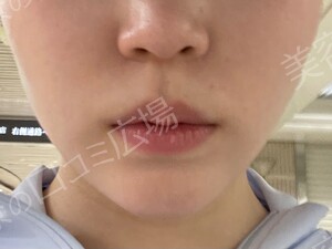 治療直後の症例写真