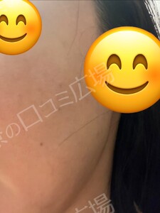 治療直後の症例写真