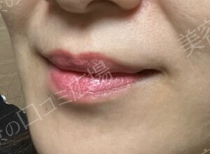 リップアートメイク 2回特別モニター施術｜6.4万円！！の治療結果の症例写真