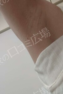 ミラドライ 両わき 1回 レベル８＋部分重複照射の治療前の症例写真
