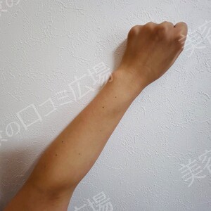 白玉ハイパー点滴（高濃度グルタチオン1200㎎）の治療前の症例写真