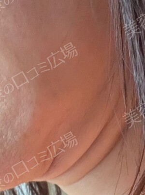椿クリニック 名古屋院のリフトアップの症例写真[ビフォー]
