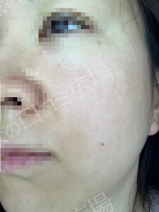 治療前の症例写真