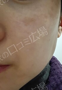 治療直後の症例写真