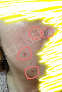 治療直後の症例写真