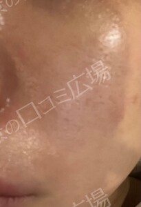 ララドクター｜低刺激ピーリング｜ララピール進化版の治療直後の症例写真
