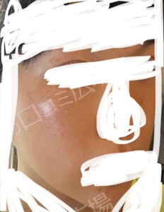 治療直後の症例写真
