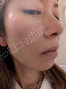 治療直後の症例写真
