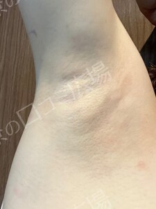 治療直後の症例写真