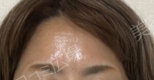 治療直後の症例写真