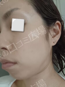 治療結果の症例写真