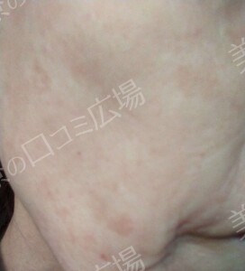 治療直後の症例写真