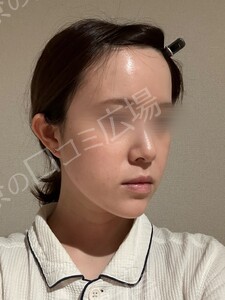 貴族手術（鼻翼基部プロテーゼ）｜ほうれい線を改善の治療結果の症例写真