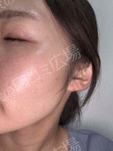 ジェネシスの治療直後の症例写真