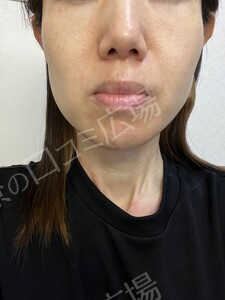 治療結果の症例写真