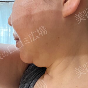 治療直後の症例写真