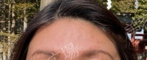 治療結果の症例写真
