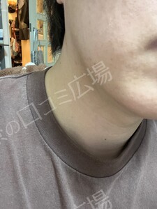 治療前の症例写真