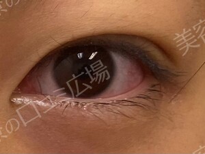 【学生限定】LS法ダブルスタンダードプラン　両目の治療直後の症例写真