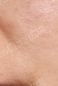 治療直後の症例写真