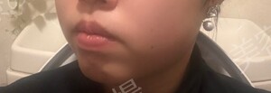 治療結果の症例写真