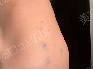治療直後の症例写真