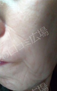 治療結果の症例写真