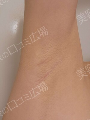 THE CLINIC NAGOYA 【ザ・クリニック名古屋】のわきが・多汗症治療の症例写真[ビフォー]