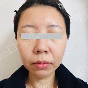 白玉ハイパー点滴（高濃度グルタチオン1200㎎）の治療直後の症例写真