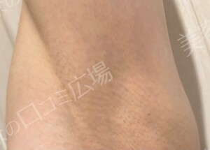治療直後の症例写真