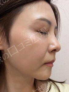 治療直後の症例写真