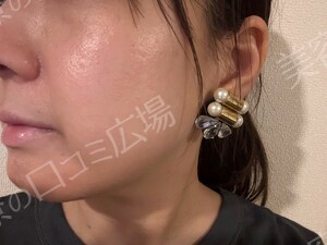 治療直後の症例写真
