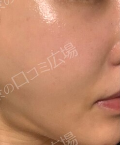 ジェネシスの治療直後の症例写真