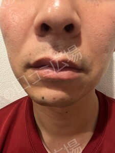 治療直後の症例写真