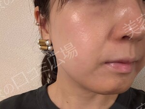 治療直後の症例写真