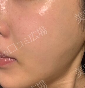 ジェネシスの治療直後の症例写真