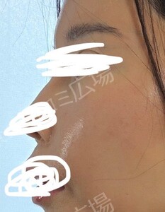 治療直後の症例写真