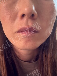 治療直後の症例写真