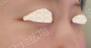 治療結果の症例写真